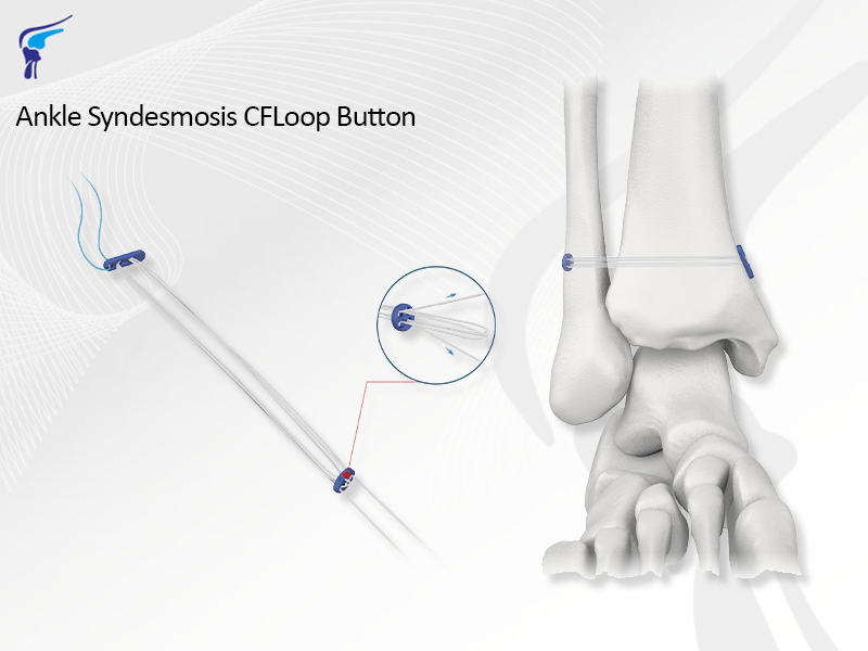 Ankle Syndesmosis CFLoop Button