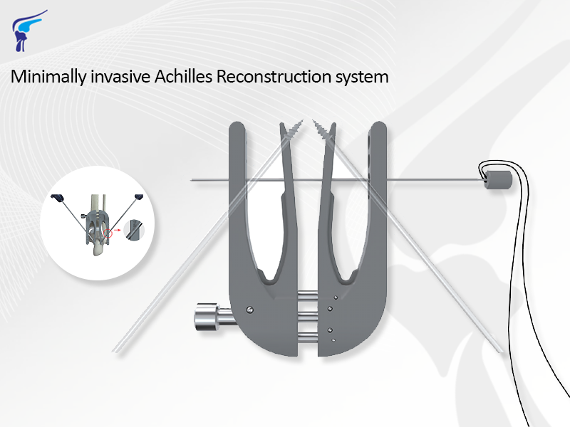 Minimally Invasive Achilles Reconstruction System
